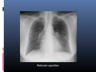 Reticular opacities 
 