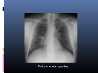 Reticulonodular opacities 
 