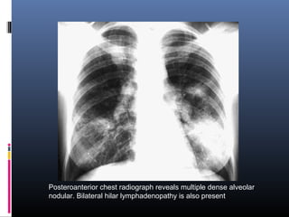 Posteroanterior chest radiograph reveals multiple dense alveolar 
nodular. Bilateral hilar lymphadenopathy is also present 
 