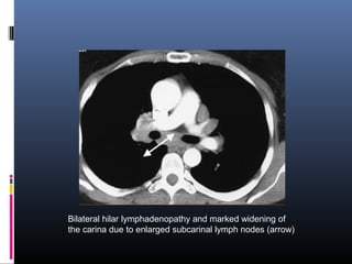 Bilateral hilar lymphadenopathy and marked widening of 
the carina due to enlarged subcarinal lymph nodes (arrow) 
 