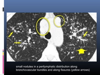 small nodules in a perilymphatic distribution along 
bronchovascular bundles and along fissures (yellow arrows) 
 
