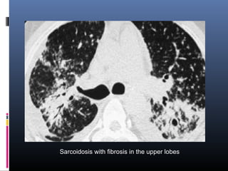 Sarcoidosis with fibrosis in the upper lobes 
 