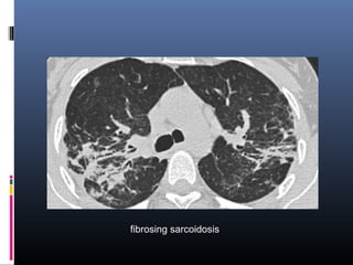 fibrosing sarcoidosis 
 