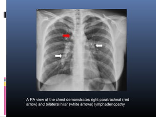 A PA view of the chest demonstrates right paratracheal (red 
arrow) and bilateral hilar (white arrows) lymphadenopathy 
 