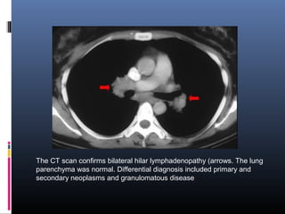 The CT scan confirms bilateral hilar lymphadenopathy (arrows. The lung 
parenchyma was normal. Differential diagnosis included primary and 
secondary neoplasms and granulomatous disease 
 