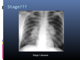Stage??? 
Stage I disease 
 