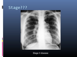Stage??? 
Stage II disease 
 