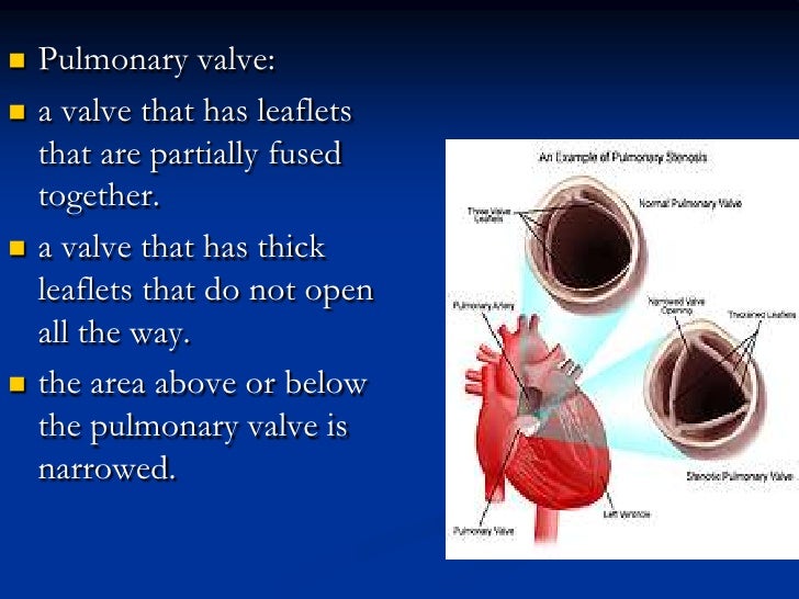 Pulmonary stenosis