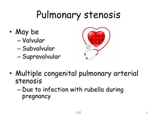 Pulmonary stenosis
• May be
– Valvular
– Subvalvular
– Supravalvular
• Multiple congenital pulmonary arterial
stenosis
– Due to infection with rubella during
pregnancy
JMJ 3
 