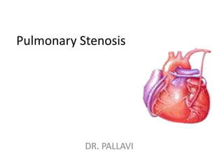 Pulmonary Stenosis
DR. PALLAVI
 