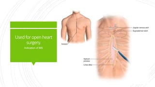 Usedforopenheart
surgery.
Indication of MS
 