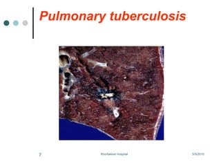 Pulmonary tuberculosis 