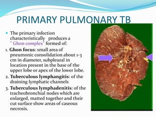PRIMARY PULMONARY TB
 The primary infection
characteristically produces a
" Ghon complex" formed of:
1. Ghon focus: small area of
pneumonic consolidation about 1-3
cm in diameter, subpleural in
location present in the base of the
upper lobe or apex of the lower lobe.
2. Tuberculous lymphangitis: of the
draining lymphatic channels
3. Tuberculous lymphadenitis: of the
tracheobronchial nodes which are
enlarged, matted together and their
cut surface show areas of caseous
necrosis.
 