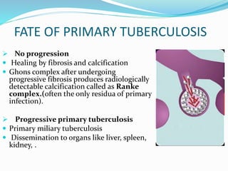 FATE OF PRIMARY TUBERCULOSIS
 No progression
 Healing by fibrosis and calcification
 Ghons complex after undergoing
progressive fibrosis produces radiologically
detectable calcification called as Ranke
complex.(often the only residua of primary
infection).
 Progressive primary tuberculosis
 Primary miliary tuberculosis
 Dissemination to organs like liver, spleen,
kidney, .
 