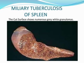 MILIARY TUBERCULOSIS
OF SPLEEN
The Cut Surface shows numerous grey white granulomas.
 