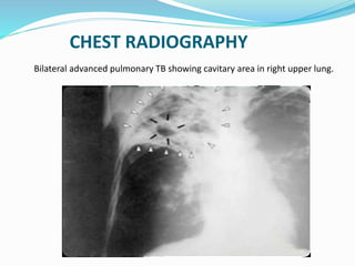 CHEST RADIOGRAPHY
Bilateral advanced pulmonary TB showing cavitary area in right upper lung.
 