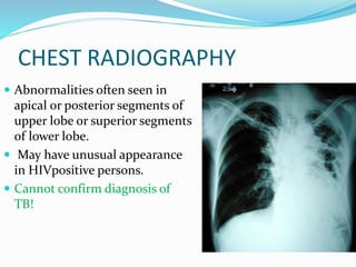 CHEST RADIOGRAPHY
 Abnormalities often seen in
apical or posterior segments of
upper lobe or superior segments
of lower lobe.
 May have unusual appearance
in HIVpositive persons.
 Cannot confirm diagnosis of
TB!
 