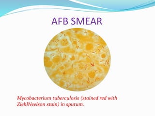 AFB SMEAR
Mycobacterium tuberculosis (stained red with
ZiehlNeelson stain) in sputum.
 