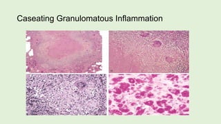 Caseating Granulomatous Inflammation
 