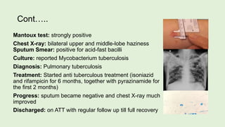 Cont…..
Mantoux test: strongly positive
Chest X-ray: bilateral upper and middle-lobe haziness
Sputum Smear: positive for acid-fast bacilli
Culture: reported Mycobacterium tuberculosis
Diagnosis: Pulmonary tuberculosis
Treatment: Started anti tuberculous treatment (isoniazid
and rifampicin for 6 months, together with pyrazinamide for
the first 2 months)
Progress: sputum became negative and chest X-ray much
improved
Discharged: on ATT with regular follow up till full recovery
 