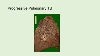Progressive Pulmonary TB
 