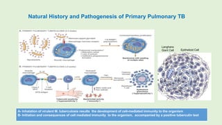 Natural History and Pathogenesis of Primary Pulmonary TB
A- Inhalation of virulent M. tuberculosis results the development of cell-mediated immunity to the organism
B- Initiation and consequences of cell mediated immunity to the organism, accompanied by a positive tuberculin test
Langhans
Giant Cell Epithelioid Cell
 
