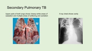 Secondary Pulmonary TB
X-ray chest shows cavityUpper parts of both lungs shows cheesy-white areas of
caseation and multiple areas of softening and cavitation
 