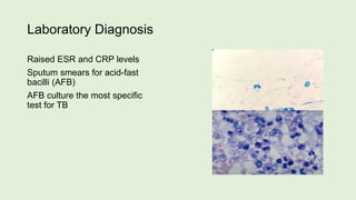 Laboratory Diagnosis
Raised ESR and CRP levels
Sputum smears for acid-fast
bacilli (AFB)
AFB culture the most specific
test for TB
 