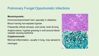 Pulmonary Fungal Opportunistic Infections
Mucormycosis:
Immunocompromised host, specially in diabetics
Mucor having non-septate hyphae
Frequently infects sinuses, oral cavity, brain & lung
Angioinvasive, hyphae growing in and around blood
vessels causing ischemia
Cryptococcosis :
Minimal inflammation, usually in lung, may spread to
meninges
 