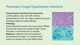 Pulmonary Fungal Opportunistic Infections
Pneumocystis (carinii) jiroveci pneumonia
In AIDS patients, often with CMV infection
Clinical features: fever, dry cough, dyspnea & hypoxia
Radiology: bilateral & basal infiltrates
Pathology
Septa thickened by edema and mononuclear infiltrate
Intra-alveolar foamy pink exudate (Cotton candy)
Encysted or trophozoite forms in exudate
Diagnosis: Organism best demonstrated in
bronchioalveolar lavage or in transbronchial
biopsy cup shaped round cysts GMS positive
GMS +
 