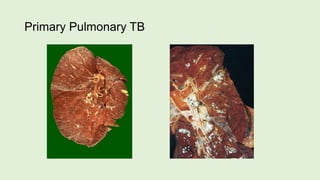 Primary Pulmonary TB
 