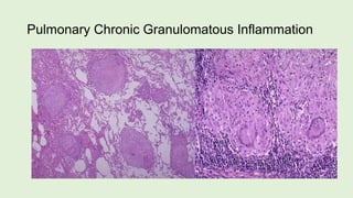 Pulmonary Chronic Granulomatous Inflammation
 