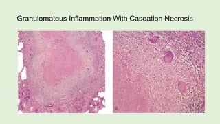 Granulomatous Inflammation With Caseation Necrosis
 