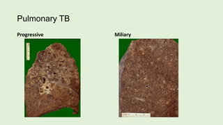 Pulmonary TB
Progressive Miliary
 