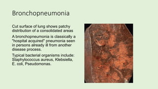 Bronchopneumonia
Cut surface of lung shows patchy
distribution of a consolidated areas
A bronchopneumonia is classically a
"hospital acquired" pneumonia seen
in persons already ill from another
disease process.
Typical bacterial organisms include:
Staphylococcus aureus, Klebsiella,
E. coli, Pseudomonas.
 
