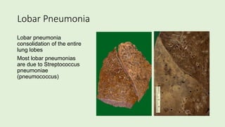 Lobar Pneumonia
Lobar pneumonia
consolidation of the entire
lung lobes
Most lobar pneumonias
are due to Streptococcus
pneumoniae
(pneumococcus)
 