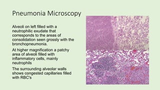 Pneumonia Microscopy
Alveoli on left filled with a
neutrophilic exudate that
corresponds to the areas of
consolidation seen grossly with the
bronchopneumonia.
At higher magnification a patchy
area of alveoli filled with
inflammatory cells, mainly
neutrophils
The surrounding alveolar walls
shows congested capillaries filled
with RBC's
 