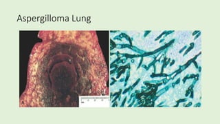 Aspergilloma Lung
 