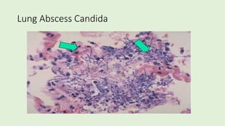 Lung Abscess Candida
 