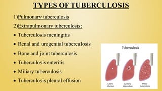 TYPES OF TUBERCULOSIS
1)Pulmonary tuberculosis
2)Extrapulmonary tuberculosis:
 Tuberculosis meningitis
 Renal and urogenital tuberculosis
 Bone and joint tuberculosis
 Tuberculosis enteritis
 Miliary tuberculosis
 Tuberculosis pleural effusion
 