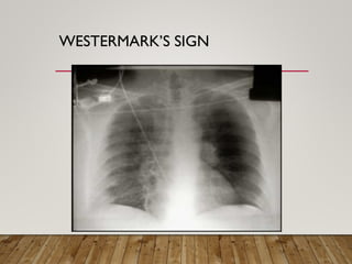 Watermark Sign Radiology PULMONARY THROMBOEMBOLISM 2025 internal medicine.ppt