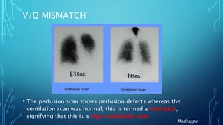 V/Q MISMATCH
• The perfusion scan shows perfusion defects whereas the
ventilation scan was normal; this is termed a mismatch,
signifying that this is a high-probability scan
Medscape
 