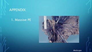 APPENDIX
1. Massive PE
Medscape
 