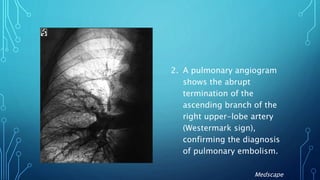 2. A pulmonary angiogram
shows the abrupt
termination of the
ascending branch of the
right upper-lobe artery
(Westermark sign),
confirming the diagnosis
of pulmonary embolism.
Medscape
 