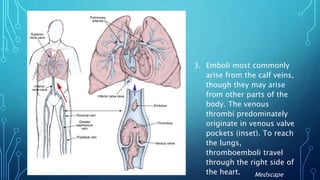 3. Emboli most commonly
arise from the calf veins,
though they may arise
from other parts of the
body. The venous
thrombi predominately
originate in venous valve
pockets (inset). To reach
the lungs,
thromboemboli travel
through the right side of
the heart. Medscape
 