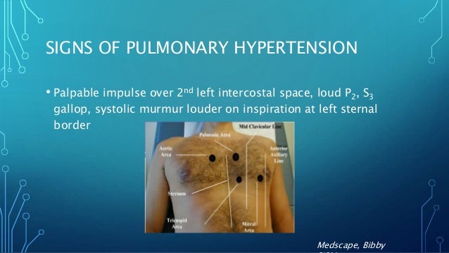 Palpable P2 What Is A Palpable P2? – Pulmonary Hypertension – MRVQ