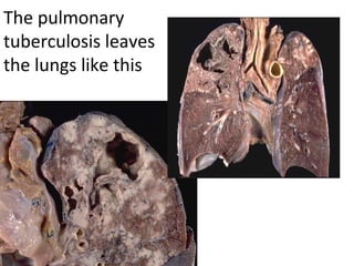 The pulmonary
tuberculosis leaves
the lungs like this
 