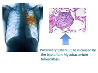 Pulmonary tuberculosis is caused by
the bacterium Mycobacterium
tuberculosis
 