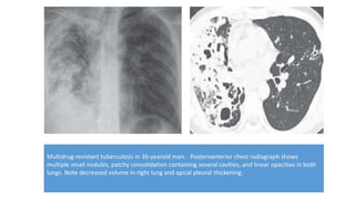 Pulmonary tuberculosis