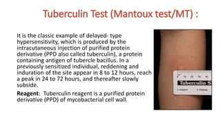 Ppd Rx Example Pulmonary Tuberculosis.pptx